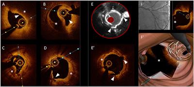 Frontiers | Editorial: Intracoronary Imaging Guidance For Percutaneous ...